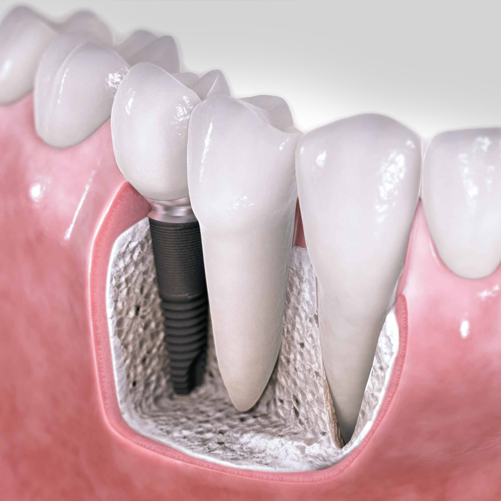 implantes dentales en Gavà y Castelldefels