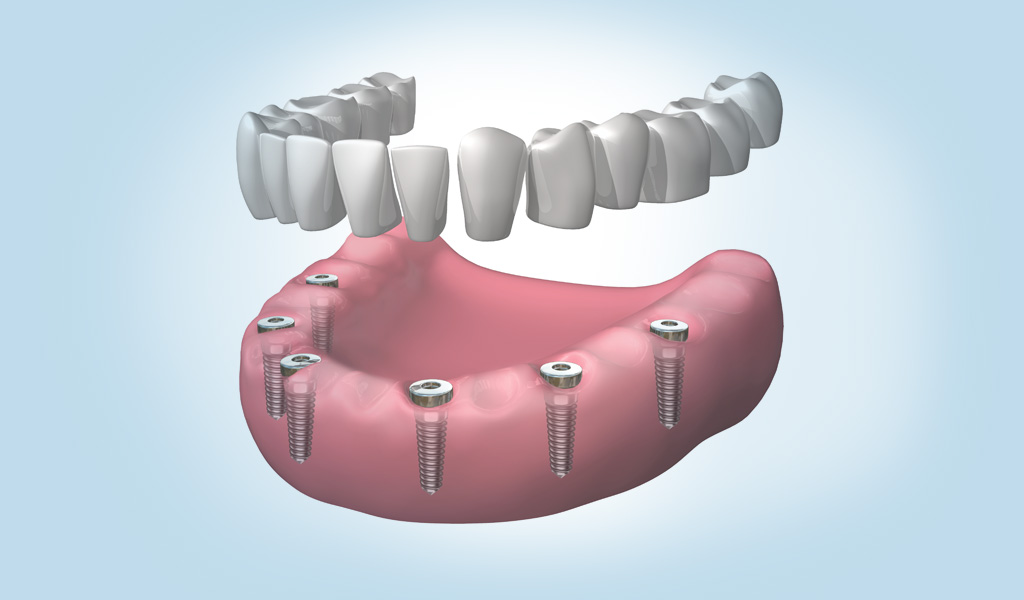 implantes dentales en Gavà y Castelldefels